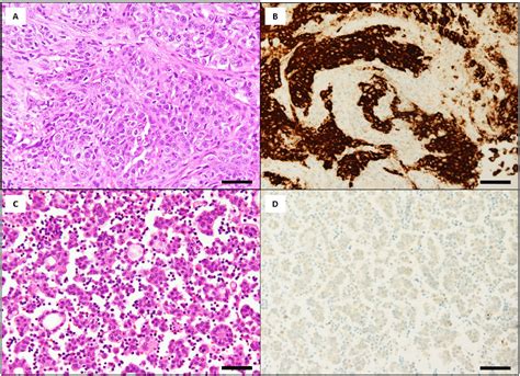 Figure 2 From A Case Of Synchronous Multiple Primary Lung