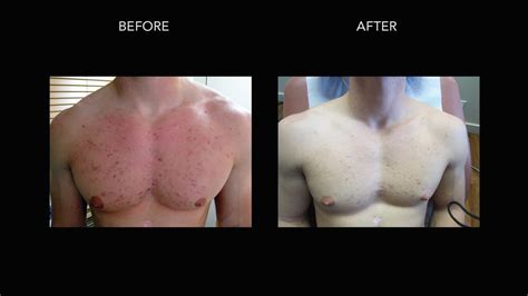 Before/After Photos | DermMedica Kelowna