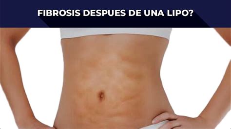 Las Verdades De La Cirug A Pl Stica Fibrosis Youtube