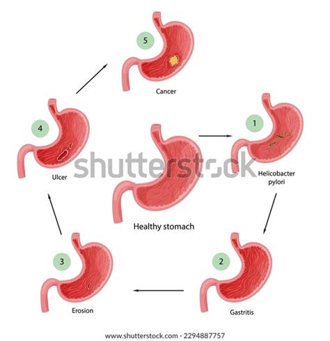 Stomach Diseases Diagram Diseases Helicobacter Pylori Stock Vector