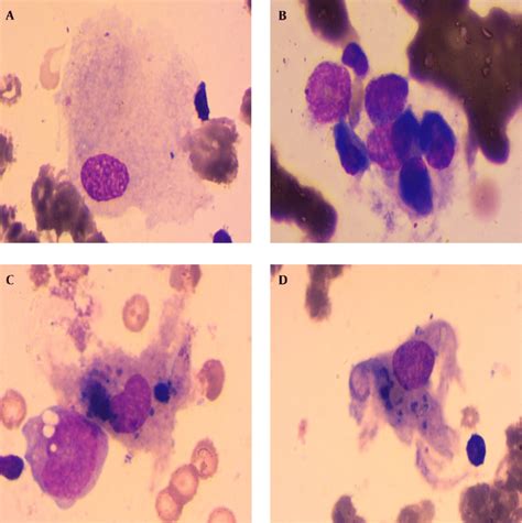 Bone Marrow Aspiration Showed Hemophagocytosis Download Scientific