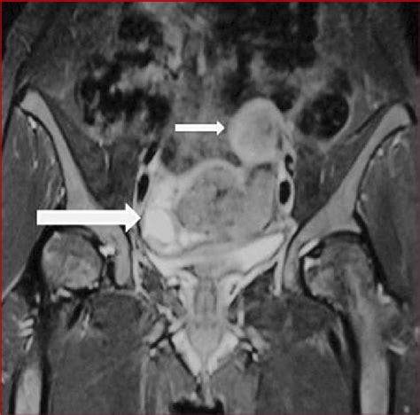 Pelvic Magnetic Resonance Imaging Of The Case Revealed A Myoma In