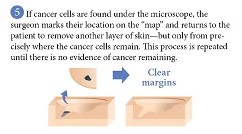 Skin Cancer Treatment Mohs Skin Cancer Treatment Pictures