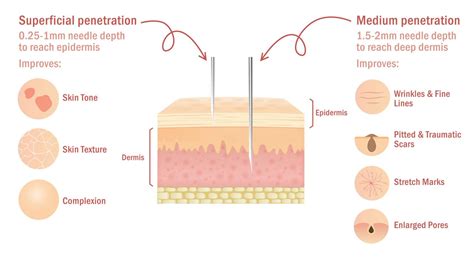 Skin Needling Dermapen 4 Scalp And Face Clinic