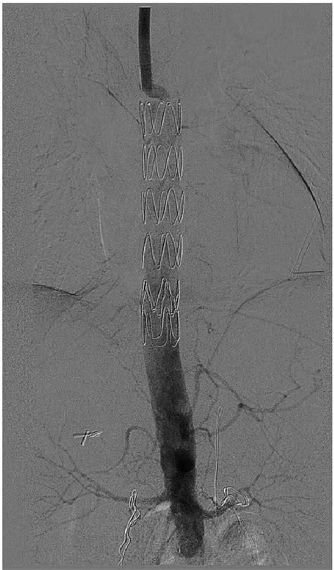 Figure From Hybrid Technique For The Management Of Thoracoabdominal