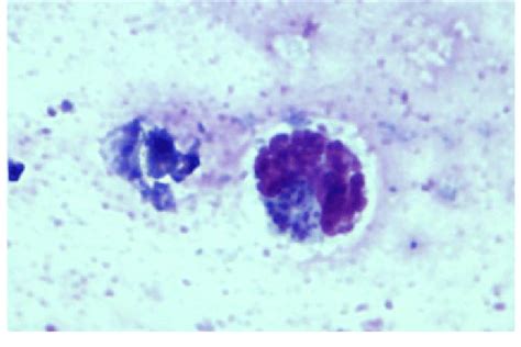 Lymph Nodes Aspirate Smear Examination Revealing Presence Of Schizonts