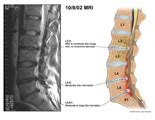 Amicus Illustration Of Amicus Radiology Mri Lumbar Disc Bulge