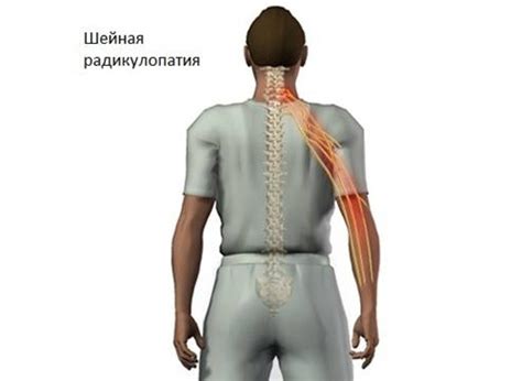 Радикулопатия шейного отдела позвоночника: симптомы и лечение
