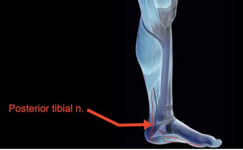 Tibial Nervetibial Nerve Dysfunction Dr Justin Dean