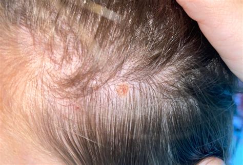 Melanoma On Scalp Symptoms