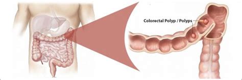 Polyp Colorectal Polyps Symptoms Types Causes And TreatmentDr D