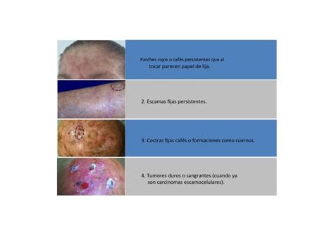 Queratosis Actínica Clinica Aurora