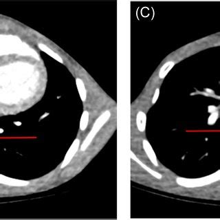 Computed Tomography CT Angiography Findings A Before Inset