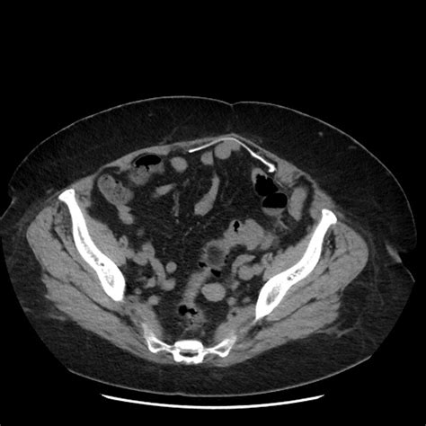 File Distal Colocolic Intussusception Due To Lipoma Epiploic