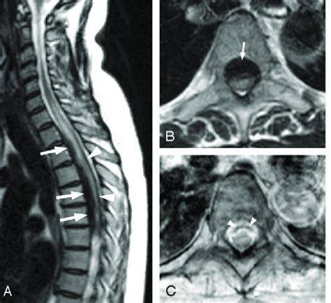 A Sagittal Fast Spin Echo Fse T Weighted Image Of The Cervical And