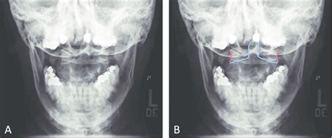 A Open Mouth Odontoid View Showing The Relationship Of The Odontoid Download Scientific