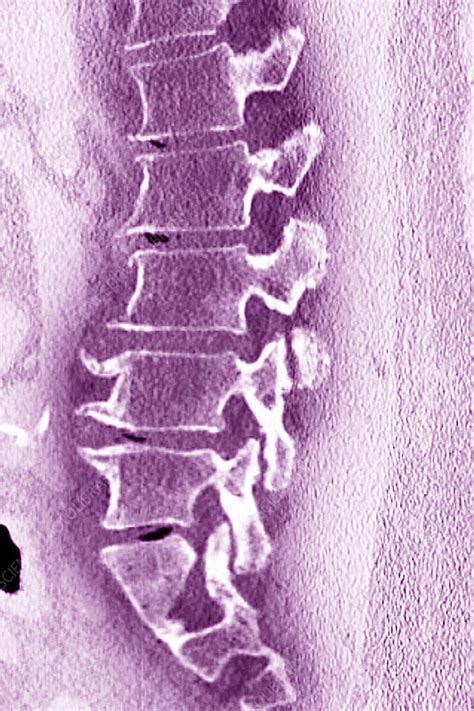 Degenerative Disc Disease X Ray Stock Image C Science