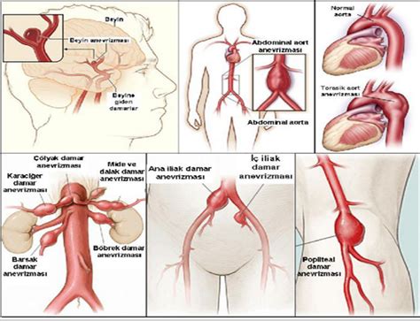 Fikir Transplantasyonu Aort Anevr Zmasi Hem Rel K Bakimi