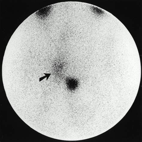 Somatostatin Receptor Scintigraphy In The Initial Staging Of Low Grade