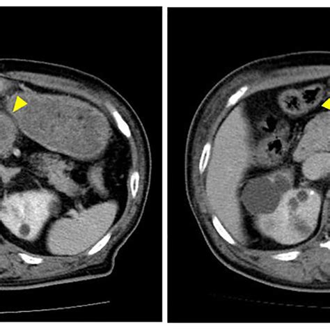 Tumor Response Contrast Enhanced Computed Tomography Revealed That The