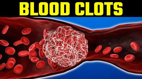 How To Dissolve And Prevent Blood Clots Naturally Youtube