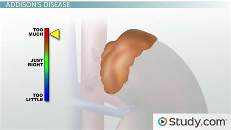 Adrenal Gland Disorders And Treatments Addison S Disease And Prednisone Lesson