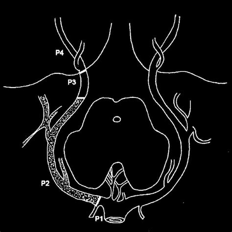 Pdf Endovascular Occlusion Of The Posterior Cerebral Artery For The