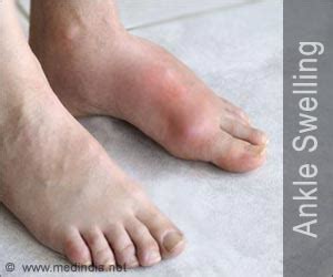 10 Causes For Swollen Feet Why Your Feet Ankles Legs