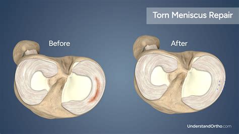 Torn Meniscus Repair Understandortho™