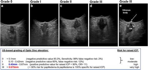 Ultrasound-based grading of optic disc elevation (ODE). a Grade 0 (mean ...