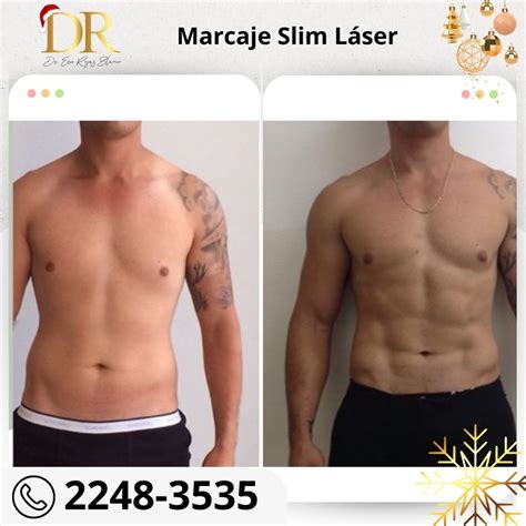 Marcaje Slim Láser con la mejor técnica Dr Eric Rojas Dermatología