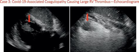 COVID-19 and the Cardiovascular System | Oncohema Key