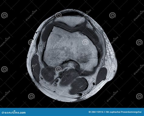 Magnetic Resonance Imaging Or Mri Of Knee Joint Axial View For Detect