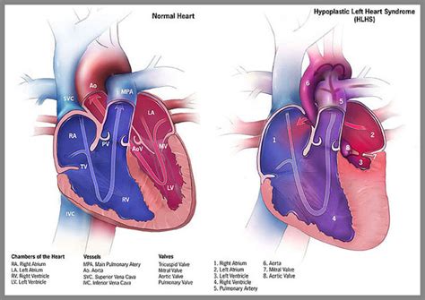 Heart Birth Defects | Hypoplastic Left Heart Syndrome