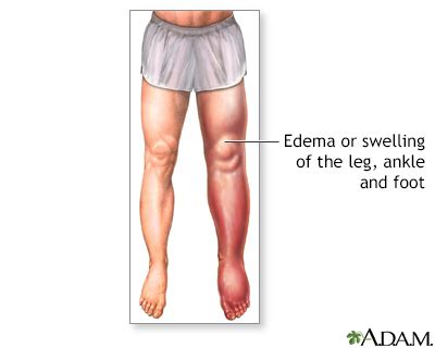 Foot Leg And Ankle Swelling Uf Health