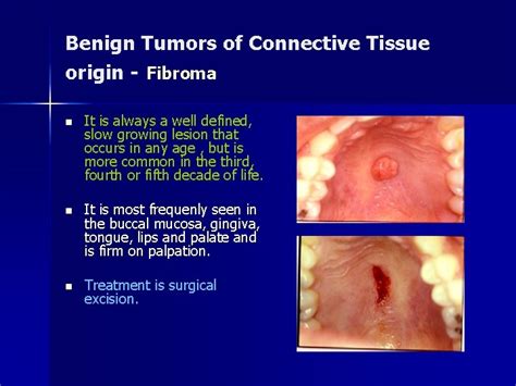 Benign Tumor