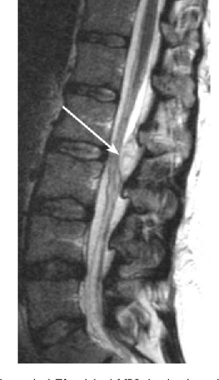 Figure 1 From Spinal Epidural Abscess A Rare Complication After