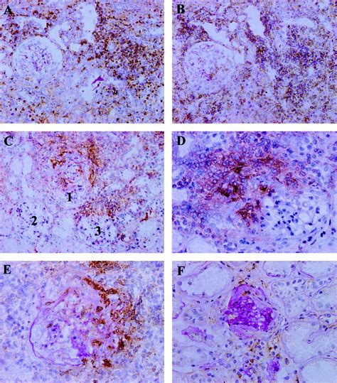 Costimulatory Molecules Cd And Cd In Human Crescentic