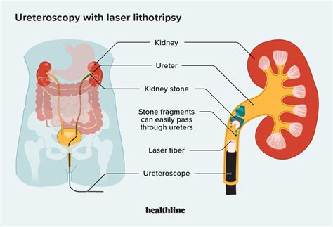 Ureteroscopy With Laser Lithotripsy Procedure Recovery Risks