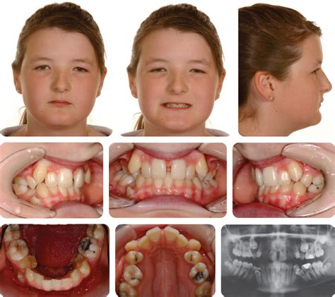 5 Class Ii Division 2 Malocclusion Pocket Dentistry