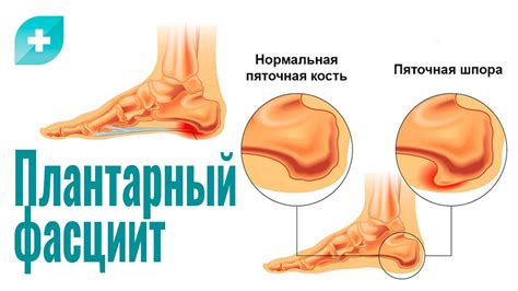 Плантарный фасциит — симптомы и лечение