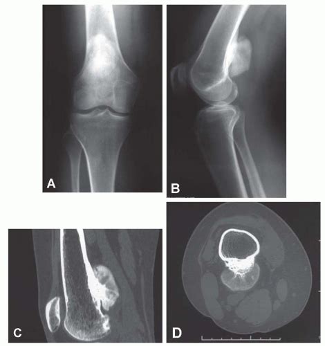 Parosteal Osteosarcoma Mri