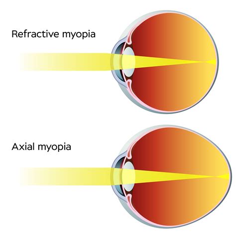 How To Get Started With Myopia Management Viewpoint