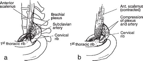 Illustration Of The Thoracic Outlet In A Person With A Cervical Rib Download Scientific Diagram