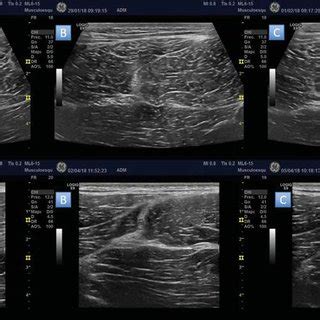 Transverse B Mode Ultrasound Images Of The Evolution Of The Injured