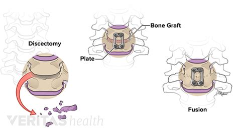 Anterior Cervical Decompression And Spine Fusion Procedure Familie