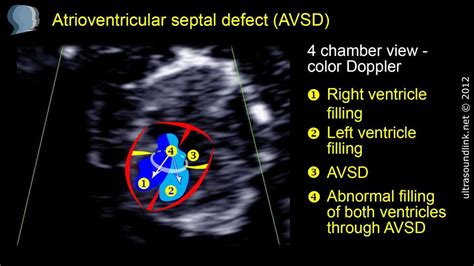 Atrioventricular Septal Defect AVSD At 11 Weeks Gestation YouTube