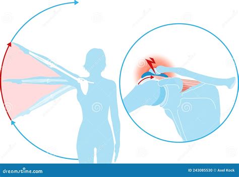 Shoulder Impingement Sydrome Painful Arc Labeled Illustration Royalty Free Stock Image