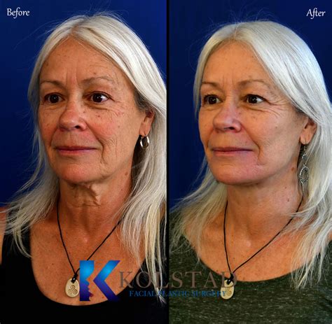 Facelift Before And After Gallery 16 Dr Kolstad San Diego Facial