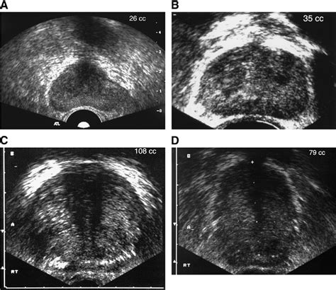 Axial Trus Images Showing Changes In Prostate Contour With Growth A